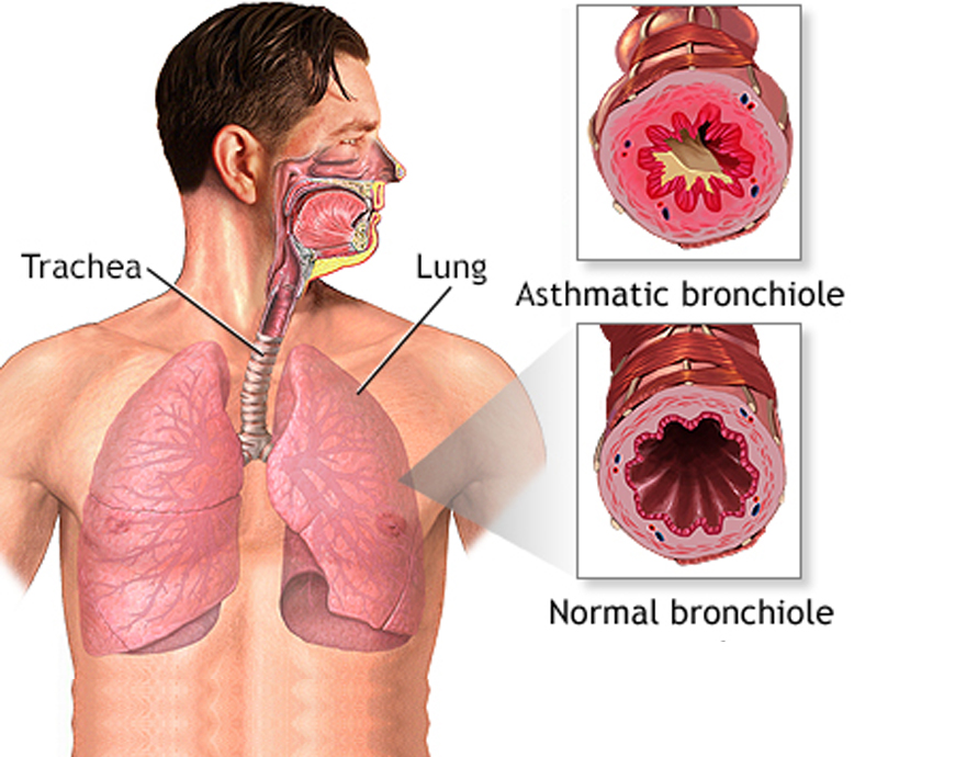 Asthma-main-image