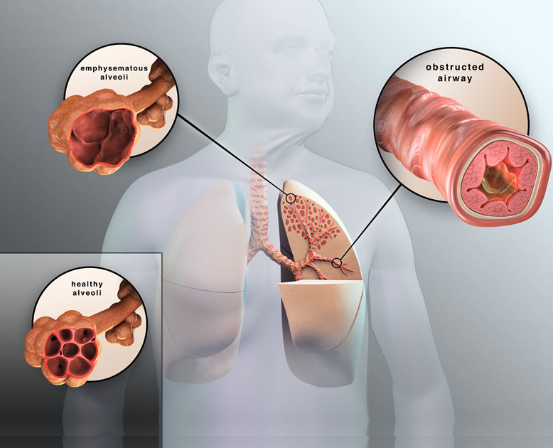 COPD image