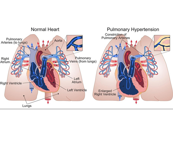 Pulmonary Arterial Hypertension  image
