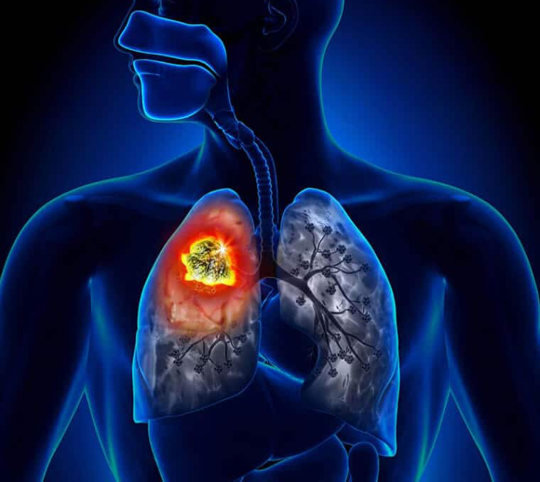 lung-cancer-main-image