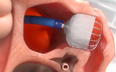 WATCHMAN™ Device: A Stroke-Prevention Option Without Lifelong Blood Thinners